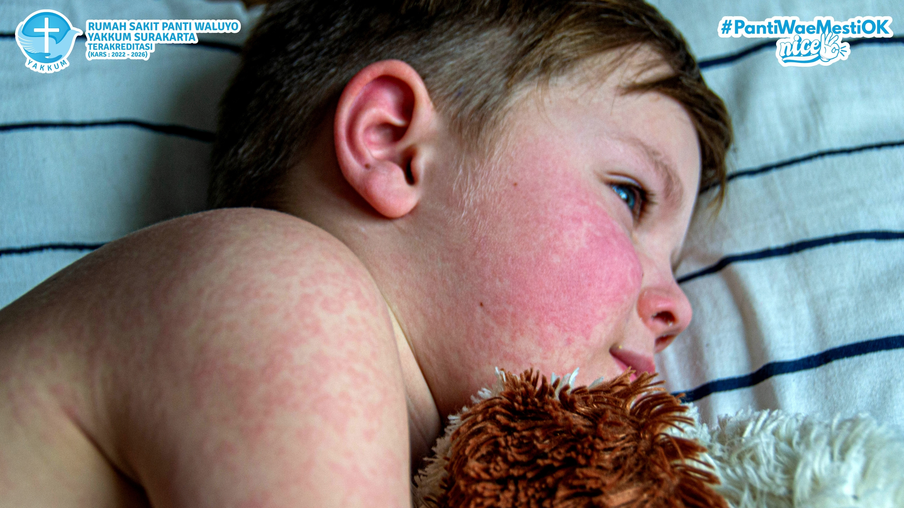 Mengenal Penyakit Campak: Gejala, Penyebab, dan Cara Pencegahannya